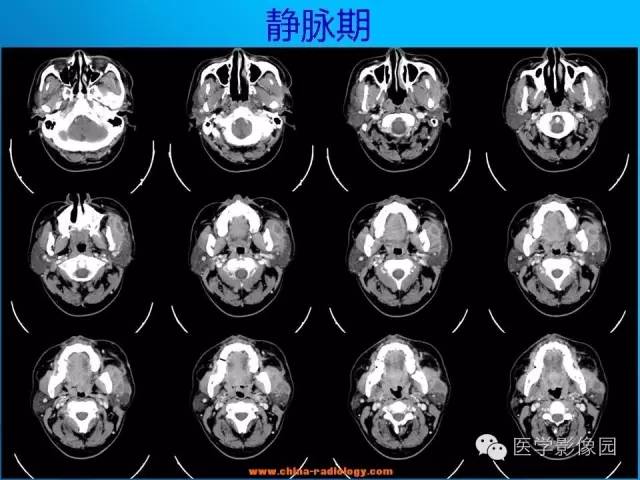 【病例】左面部朗格汉斯细胞组织细胞增生症1例CT