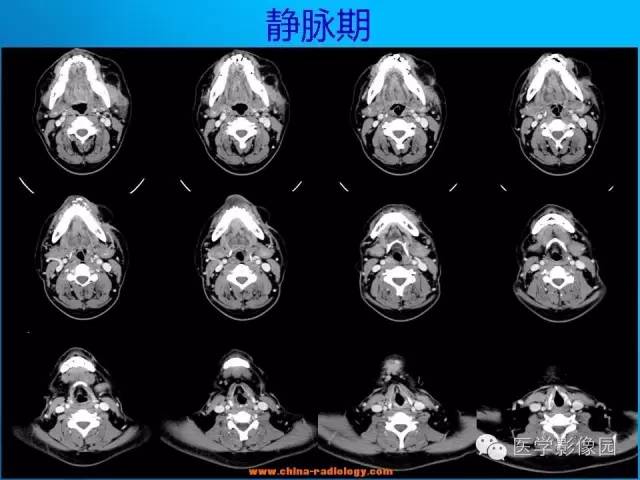 【病例】左面部朗格汉斯细胞组织细胞增生症1例CT