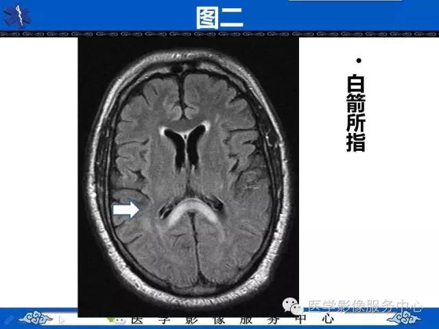【影像征象】回力标征