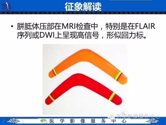 【影像征象】回力标征