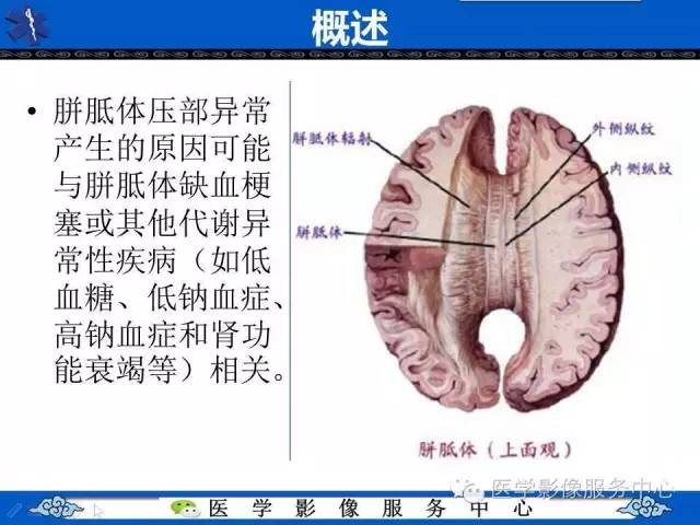 【影像征象】回力标征