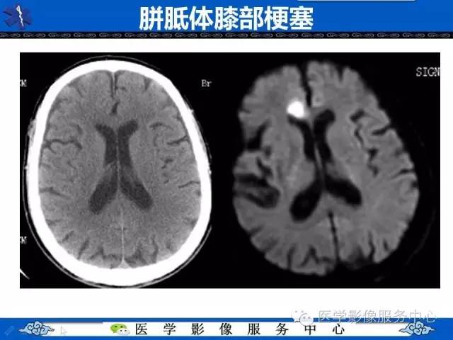 【影像征象】回力标征