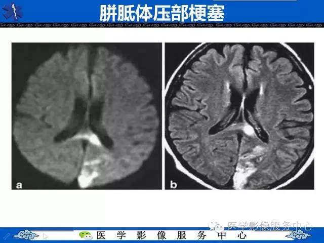 【影像征象】回力标征