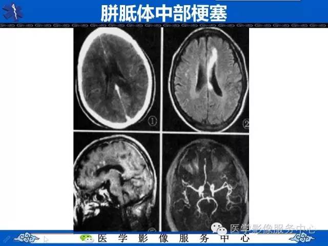 【影像征象】回力标征