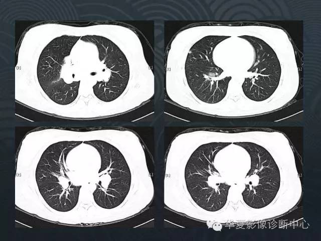 【病例】肺结节病1例CT影像表现