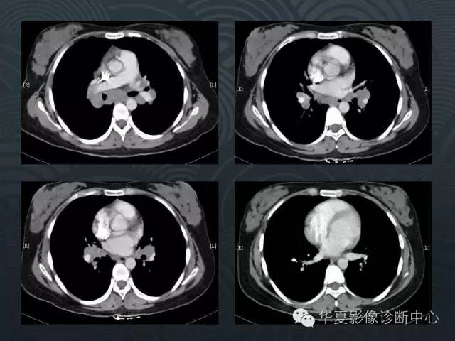 【病例】肺结节病1例CT影像表现