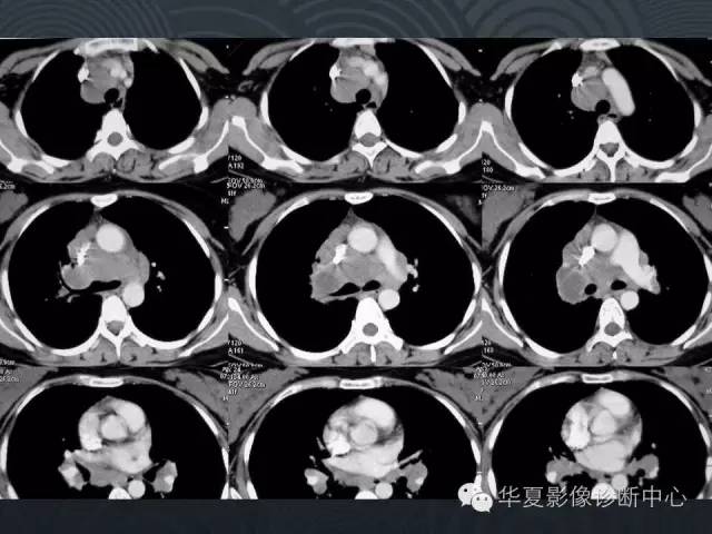 【病例】肺结节病1例CT影像表现