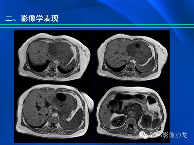【病例】肝脏淋巴瘤1例MR影像表现