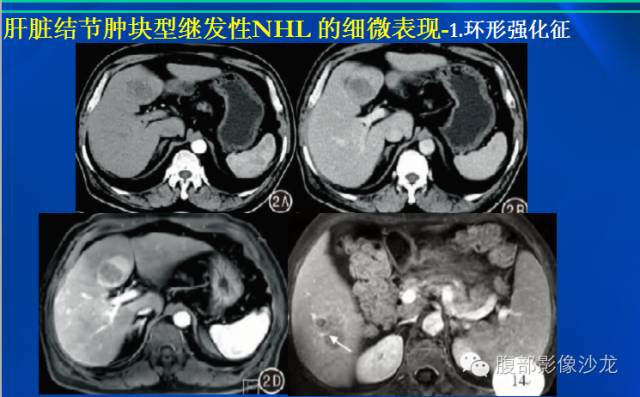【病例】肝脏淋巴瘤1例MR影像表现