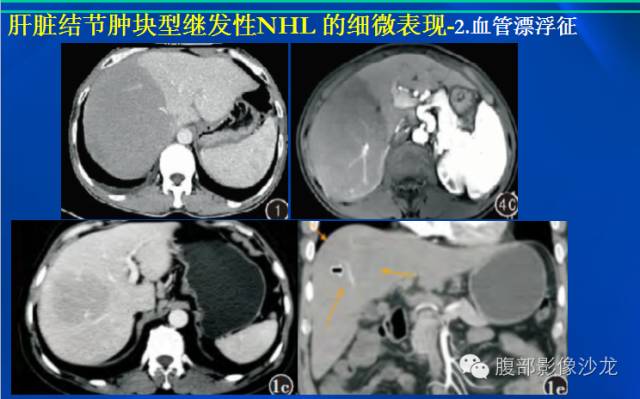 【病例】肝脏淋巴瘤1例MR影像表现