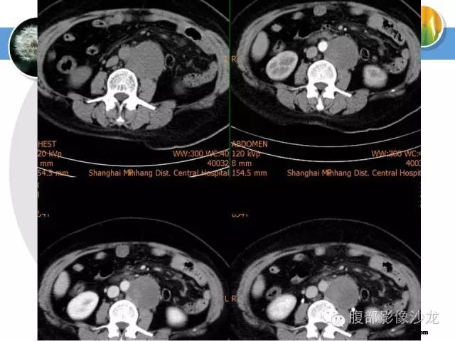 【病例】腹膜后淋巴结滤泡型淋巴瘤1例CT及MR影像表现 【病例】腹膜后淋巴结滤泡型淋巴瘤1例CT及MR影像表现