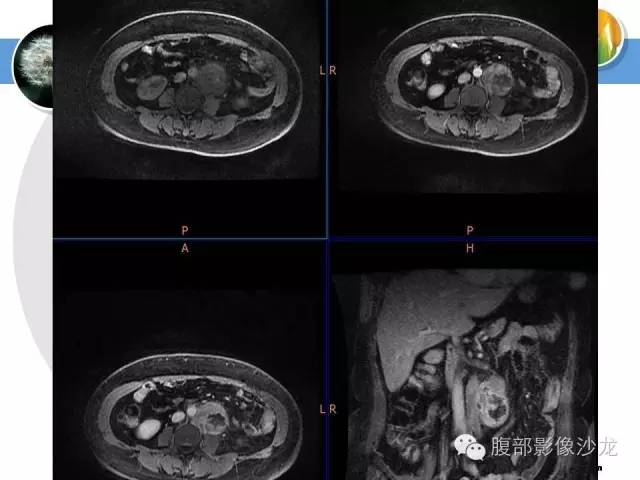 【病例】腹膜后淋巴结滤泡型淋巴瘤1例CT及MR影像表现 【病例】腹膜后淋巴结滤泡型淋巴瘤1例CT及MR影像表现
