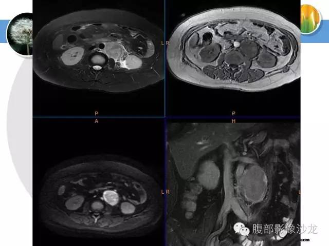 【病例】腹膜后淋巴结滤泡型淋巴瘤1例CT及MR影像表现 【病例】腹膜后淋巴结滤泡型淋巴瘤1例CT及MR影像表现