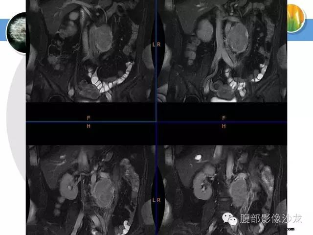 【病例】腹膜后淋巴结滤泡型淋巴瘤1例CT及MR影像表现 【病例】腹膜后淋巴结滤泡型淋巴瘤1例CT及MR影像表现