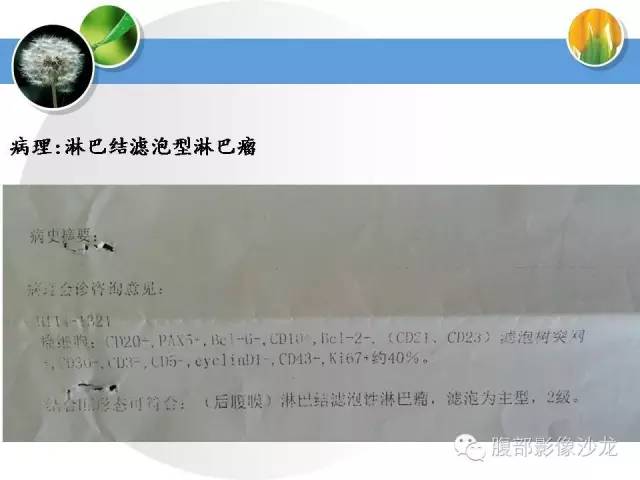 【病例】腹膜后淋巴结滤泡型淋巴瘤1例CT及MR影像表现 【病例】腹膜后淋巴结滤泡型淋巴瘤1例CT及MR影像表现