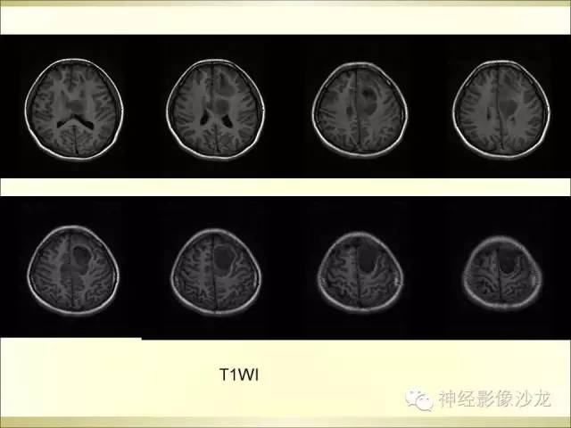 【病例】幕上原始神经外胚层肿瘤PNET1例MR影像表现