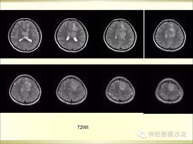 【病例】幕上原始神经外胚层肿瘤PNET1例MR影像表现