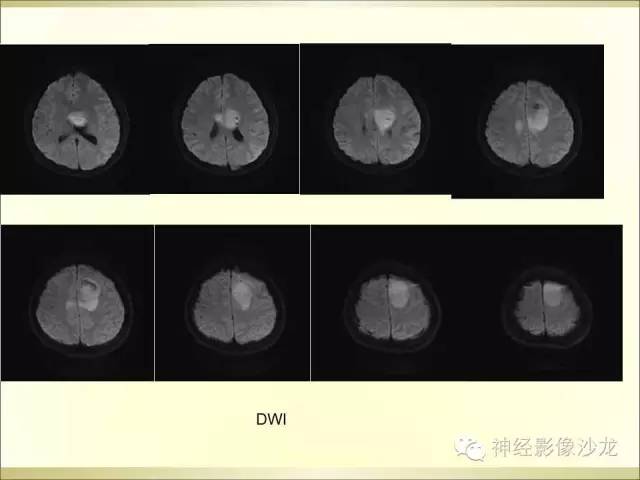 【病例】幕上原始神经外胚层肿瘤PNET1例MR影像表现