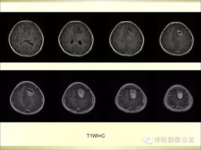 【病例】幕上原始神经外胚层肿瘤PNET1例MR影像表现