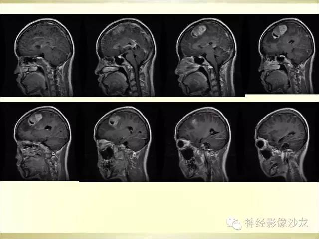 【病例】幕上原始神经外胚层肿瘤PNET1例MR影像表现