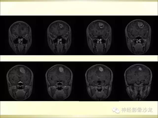 【病例】幕上原始神经外胚层肿瘤PNET1例MR影像表现