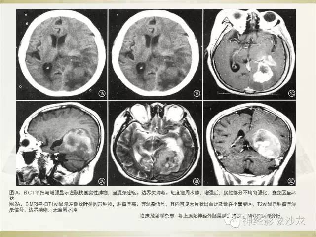 【病例】幕上原始神经外胚层肿瘤PNET1例MR影像表现