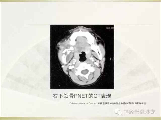 【病例】幕上原始神经外胚层肿瘤PNET1例MR影像表现
