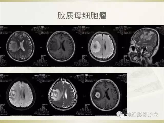 【病例】幕上原始神经外胚层肿瘤PNET1例MR影像表现