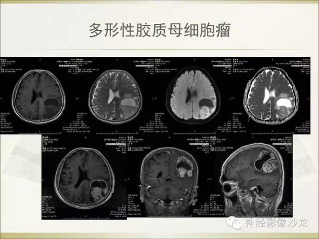 【病例】幕上原始神经外胚层肿瘤PNET1例MR影像表现