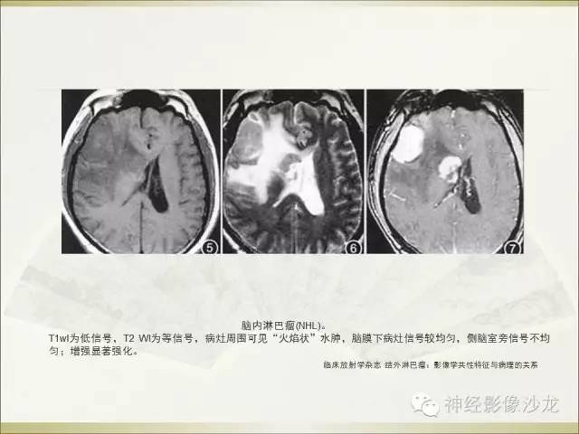 【病例】幕上原始神经外胚层肿瘤PNET1例MR影像表现
