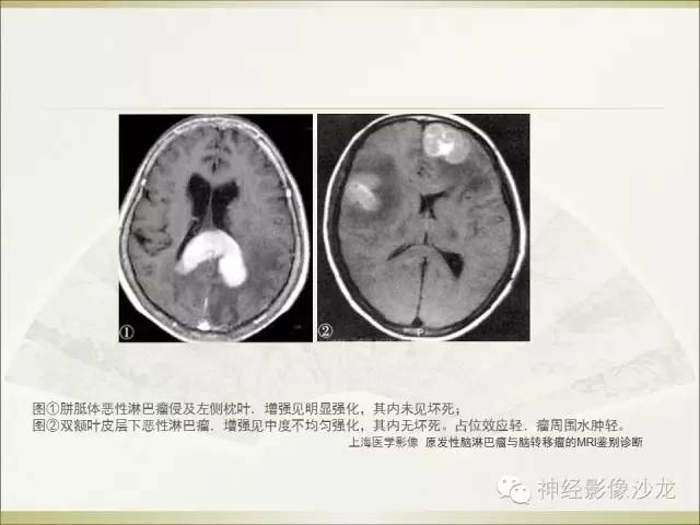 【病例】幕上原始神经外胚层肿瘤PNET1例MR影像表现