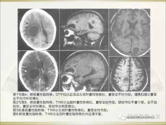 【病例】幕上原始神经外胚层肿瘤PNET1例MR影像表现
