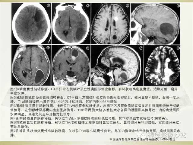 【病例】幕上原始神经外胚层肿瘤PNET1例MR影像表现