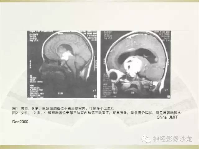 【病例】幕上原始神经外胚层肿瘤PNET1例MR影像表现