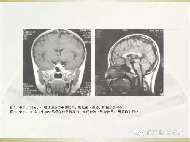 【病例】幕上原始神经外胚层肿瘤PNET1例MR影像表现
