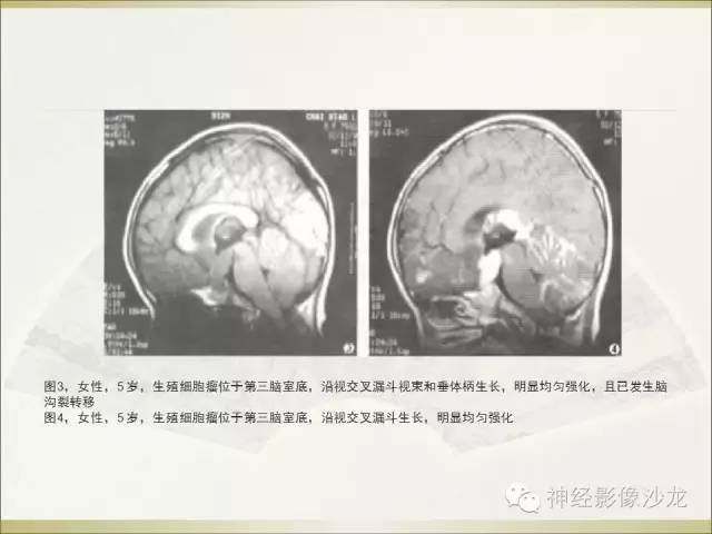 【病例】幕上原始神经外胚层肿瘤PNET1例MR影像表现