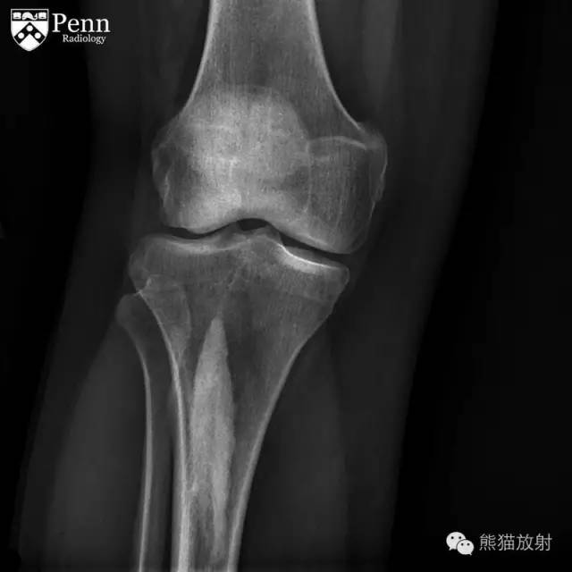 【双语病例】烛泪样骨质增生症1例