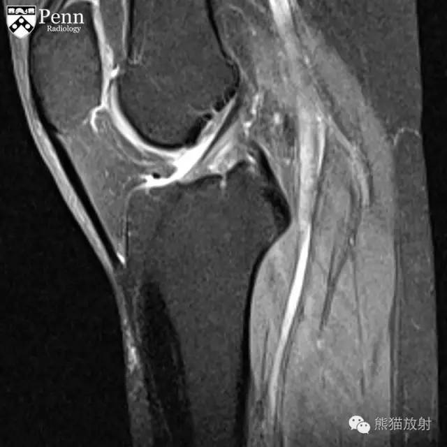 【双语病例】烛泪样骨质增生症1例 【双语病例】烛泪样骨质增生症1例