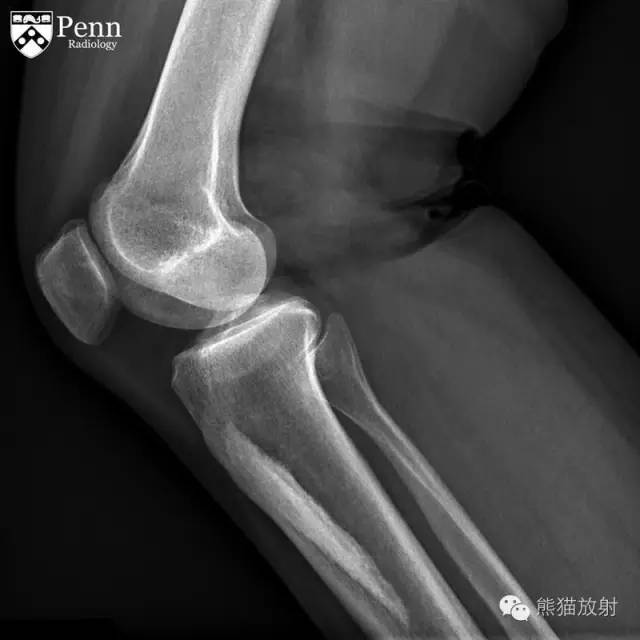 【双语病例】烛泪样骨质增生症1例 【双语病例】烛泪样骨质增生症1例
