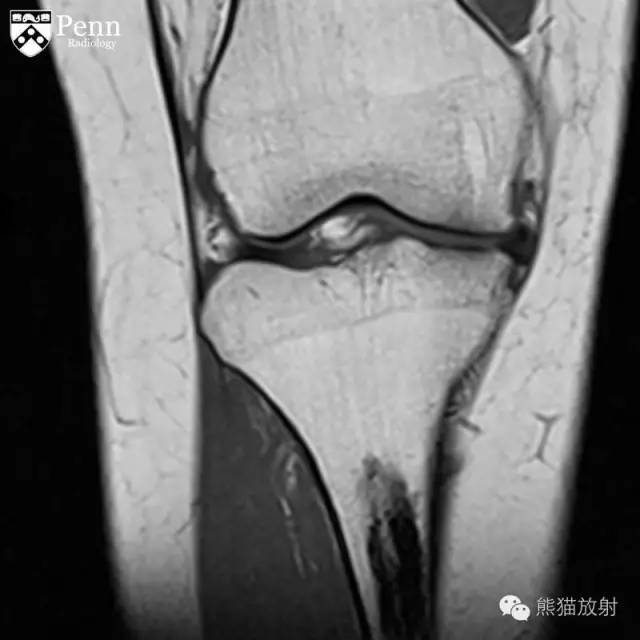 【双语病例】烛泪样骨质增生症1例 【双语病例】烛泪样骨质增生症1例