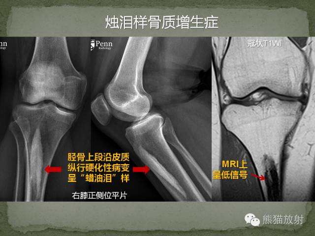 【双语病例】烛泪样骨质增生症1例 【双语病例】烛泪样骨质增生症1例