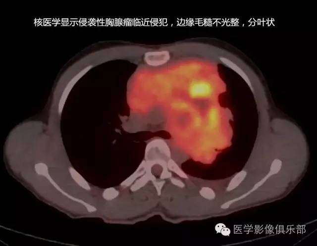 胸腺瘤的CT诊断与鉴别诊断