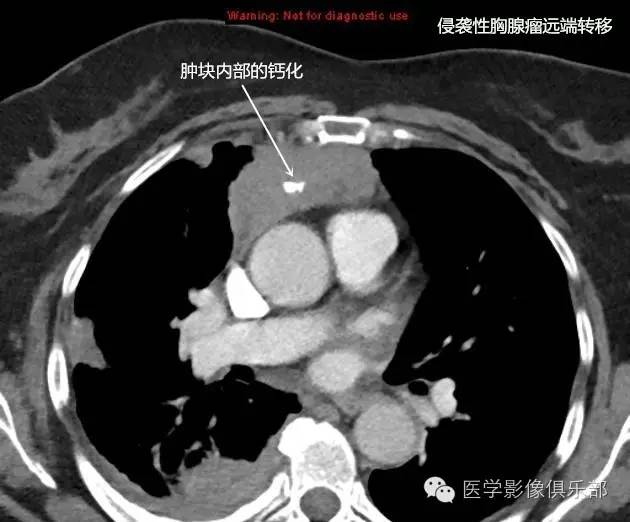 胸腺瘤的CT诊断与鉴别诊断