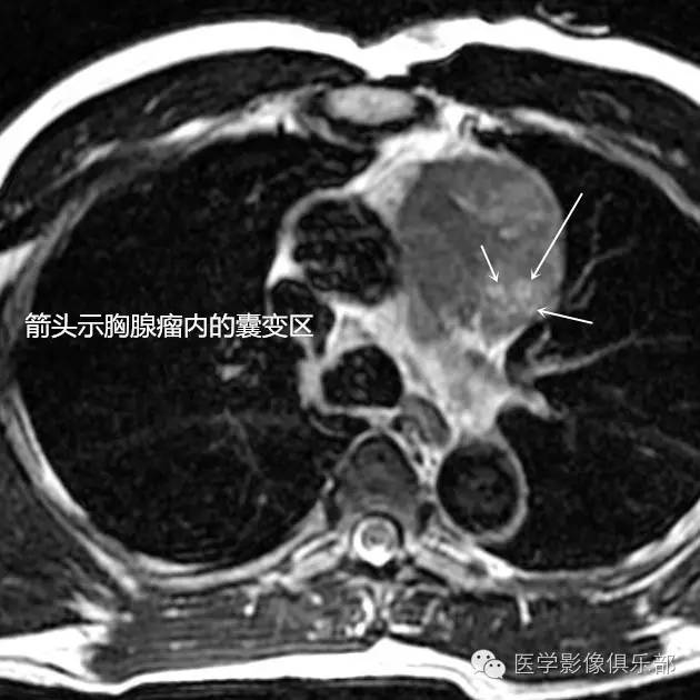 胸腺瘤的CT诊断与鉴别诊断