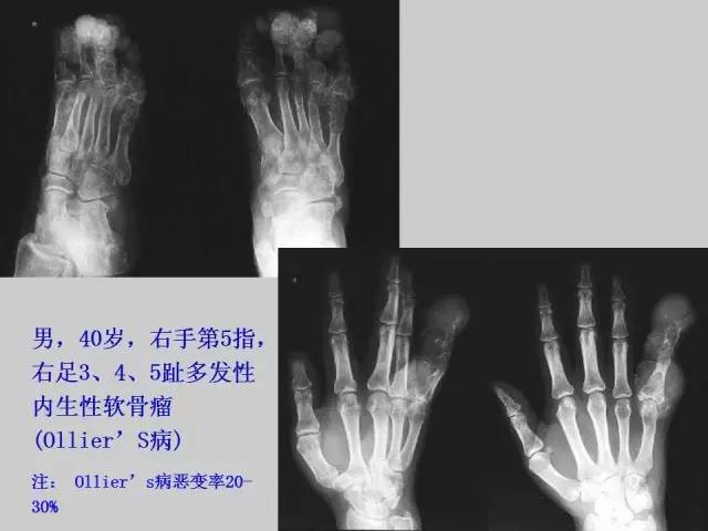 【PPT】2013版骨肿瘤WHO新分类及影像解读