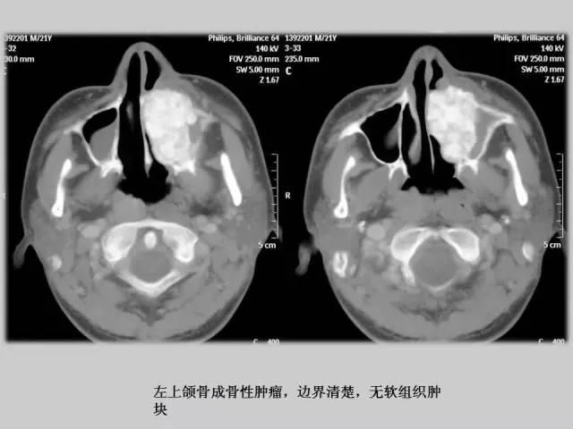 【PPT】2013版骨肿瘤WHO新分类及影像解读