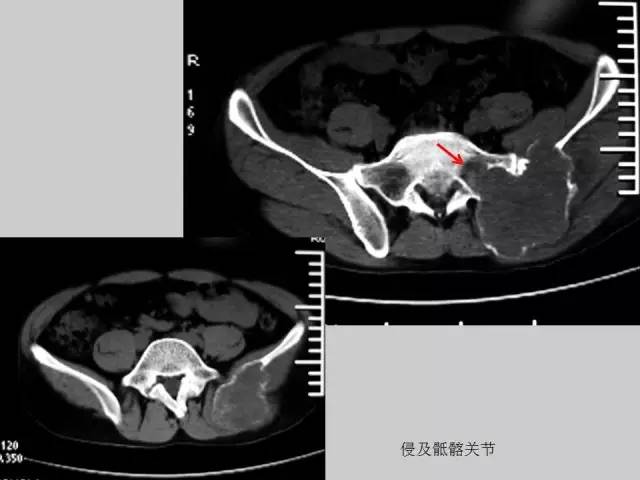 【PPT】2013版骨肿瘤WHO新分类及影像解读