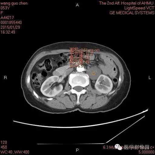 【病例】腹膜后神经鞘瘤1例CT影像表现与鉴别 【病例】腹膜后神经鞘瘤1例CT影像表现与鉴别