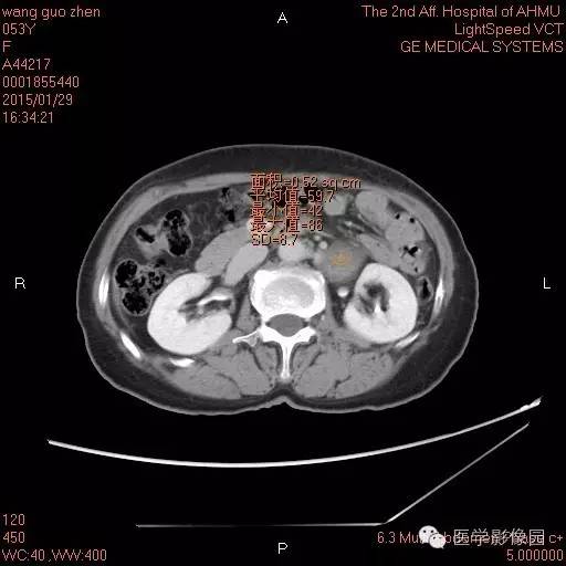 【病例】腹膜后神经鞘瘤1例CT影像表现与鉴别 【病例】腹膜后神经鞘瘤1例CT影像表现与鉴别