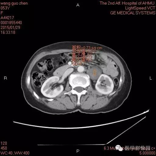 【病例】腹膜后神经鞘瘤1例CT影像表现与鉴别 【病例】腹膜后神经鞘瘤1例CT影像表现与鉴别
